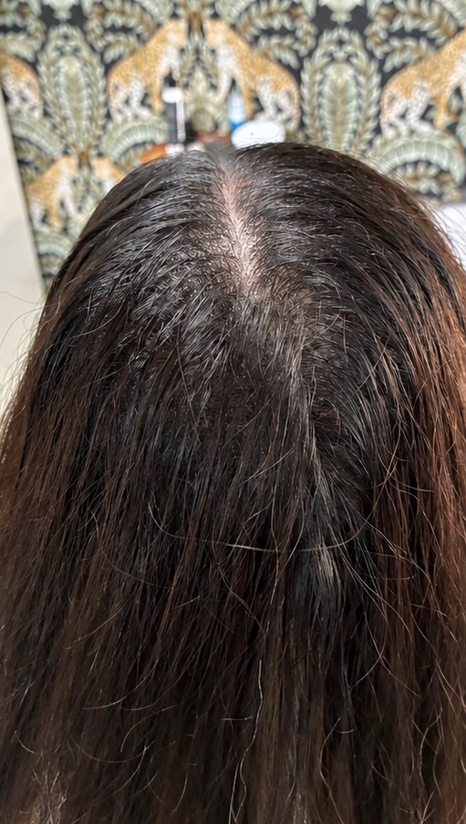 After scalp micropigmentation: widening part