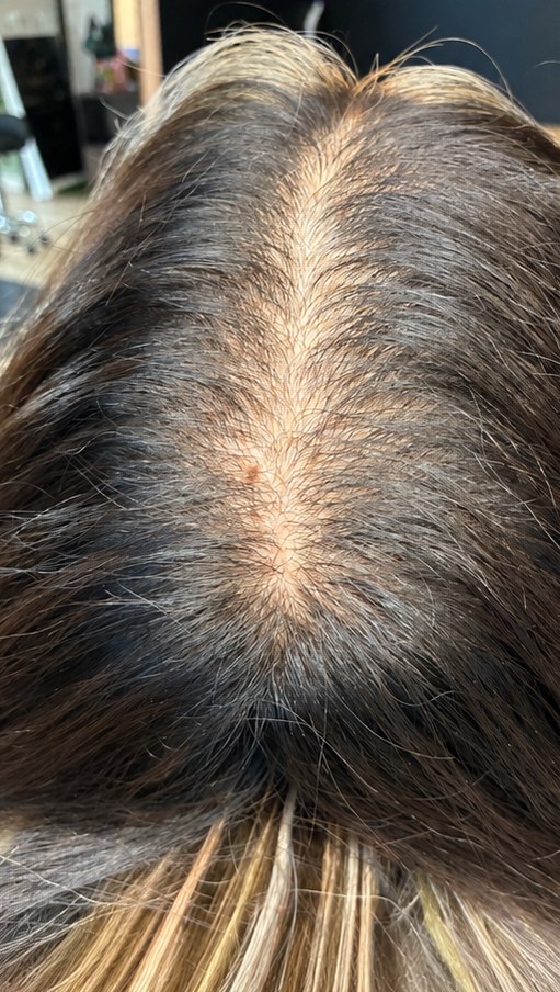 Before scalp micropigmentation: widening part