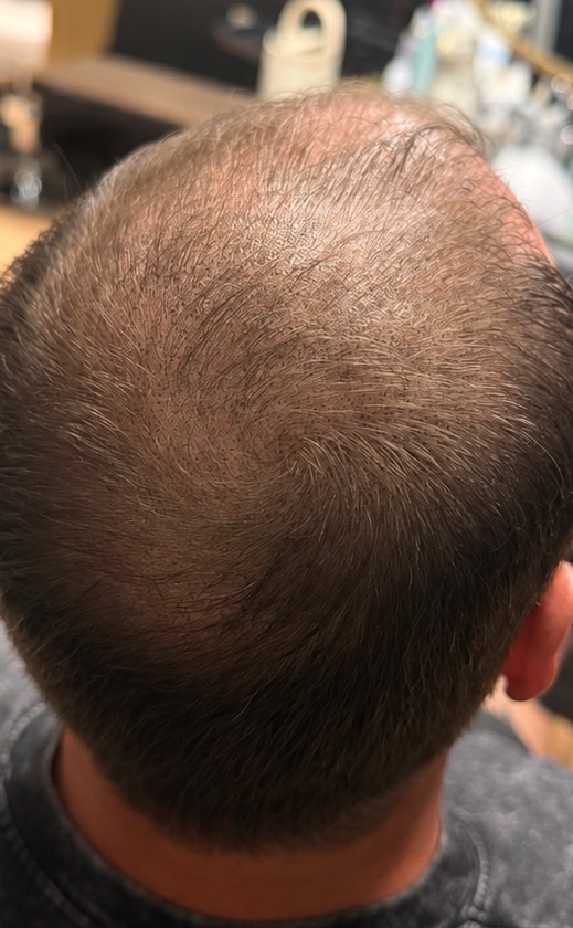 After scalp micropigmentation: thinning hair on top