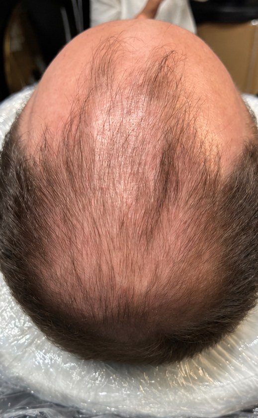 Before scalp micropigmentation: thinning hair on top